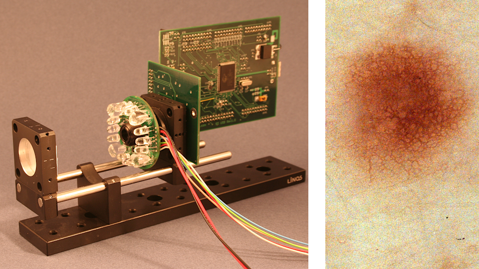 Siascope breadboard, image of skin mole